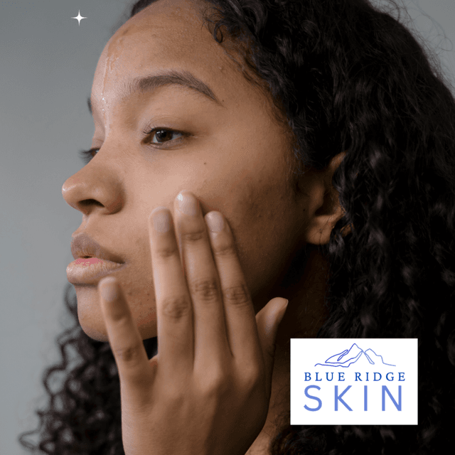 Acne Bootcamp at Blue Ridge Skin in staunton, VA