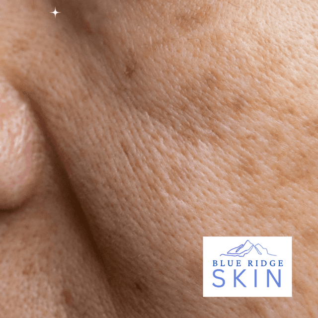 Even Skin Model Package at Blue Ridge Skin in staunton, VA